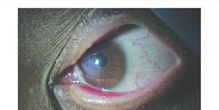 What are the symptoms of keratoconus? Corneal Hydrops Breaks In Descemet S Membrane In Severe Keratoconus Download Scientific Diagram