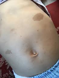 ユノの母斑の認識 | ☆レックリングハウゼン病と共に歩む事☆生きやすい世の中へ…1男5女のママブログ