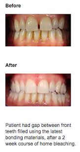 Maybe you would like to learn more about one of these? Cosmetic Bonding Weston Super Mare Fix Gaps In Teeth Burnham Clevedon