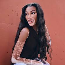 Image result for Vitiligo