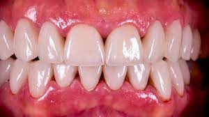 55 years of innovation · clinically proven · ada accepted What Are Black Triangles Between Your Teeth