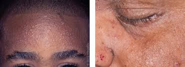 Image result for ekzema face