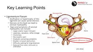 Flavum — see ligamentum flavum … medicaldictionary. Image Result For Ligamentum Flavum Spinal Stenosis Nerve Weakness Lower Limb