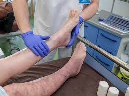 (transitive, intransitive, pathology) to affect with, or be affected by, thrombosis. Kann Kompression Einer Thrombose Vorbeugen