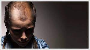 Others may cover it up with hairstyles, makeup, hats or scarves. Hair Loss And Hair Thinning Can Happen To Female Teens Hair Loss
