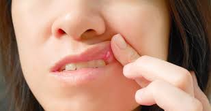 Bitkisel Cozum Agiz Yarasina Ne Iyi Gelir Nasil Gecer Agiz Ici Yarasi Afta Iyi Gelen Seyler Saglik Haberleri