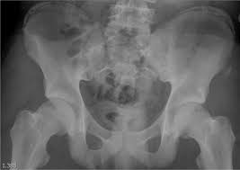 A hip fracture is a common injury, especially in people with osteoporosis. Hip Pain In An Adolescent After Injury While Playing Football The Bmj