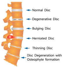Check spelling or type a new query. Herniated And Bulging Discs Symptoms To Look For Physical Therapyloudoun Sports Therapy Center