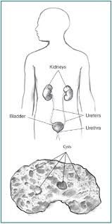 Renal disease is a relatively common complication in patients with human immunodeficiency virus (hiv) disease. Acquired Cystic Kidney Disease Niddk