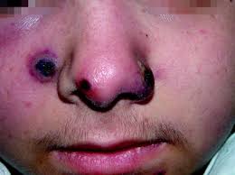Unlabelled nasal cavities foreign bodies are common accidents in children, sometimes leading, in accordance with the literature… objective to study neuroendocrine cells and nerves in vestibular glands of patients with vestibulitis. Nasal Vestibulitis And Nasal Furunculosis And Mucormycosis Springerlink