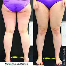 Ein Jahr Post Op Was Hat Die Liposuktion Bewirkt Lipodem Mode