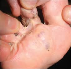 The bulk of the foreground is my liver. An Old Woman With A Very Different Purple Toe Consultant360