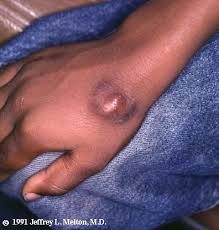 Image result for Human Bite