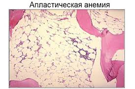 Лечение апластической анемии в государственном медицинском центре рамбам проводится только высококвалифицированными специалистами на самом современном оборудовании. Aplasticheskaya Anemiya Prichiny Simptomy I Lechenie