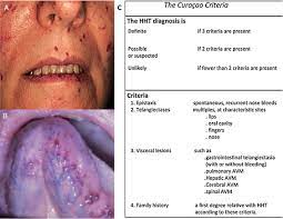 Neurological Involvement In Hereditary Hemorrhagic Telangiectasia Sciencedirect