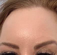 Orange peel skin refers to enlarged pores and dimpled skin texture. Skin Concern My Forehead Looks Like An Orange Peel Is There Anything I Can Do About This Skincareaddiction