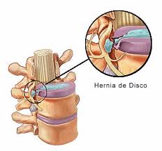 Gestation valer a mitigar sintomas de comitiva cervical inflamada grief cervical, puede que tenga que estrechar sus actividades. Hernia De Disco Cervical