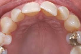 Somit sind sie beim essen als auch bei der täglichen mundhygiene absolut unbedenklich. Beauty Aligner Das Geheimnis Schoner Zahne Beauty Aligner Das Geheimnis Schoner Zahne