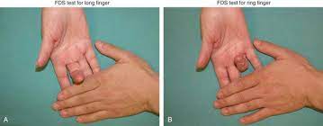 Learn vocabulary, terms and more with flashcards, games and other study tools. 31 Tendon Transfers For Extensor And Flexor Tendon Ruptures Clinical Gate