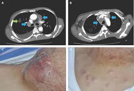 What is the prognosis for thyroid cancer? Unusual Presentation Of Anaplastic Thyroid Carcinoma With Diffuse Neck And Thoracic Nodules And Hyperthyroidism Sciencedirect