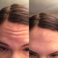 As annoying and stubborn as they may be, lines on the forehead in particular are also very common, because our eyebrows are responsible for so many of our expressions. Routine Help 21 With Forehead Wrinkles Skincareaddiction