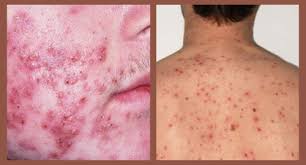 Find the best treatments and procedures for you. Best Acne Treatment In Ayurveda To Clean Up Your Skin