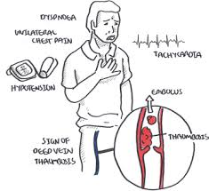 Pulmonary Embolism Armando Hasudungan