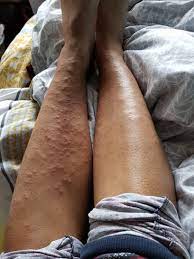Hello, folliculitis is common after hair removal.after laser hair removal, apply cold compresses(ice cubes wrapped in a towel) on the rash and take some antihistaminic like benadryl or claritin.you can also apply calamine lotion on the rash.it will help in soothing the skin. Laser Hair Allergic Reaction Or Something Else I Ve Had 2 Sessions Of Laser Hair Removal Photos
