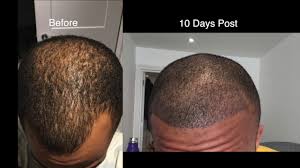 Older hair loss treatment has caused scarring and patients were disappointed because. Week 2 Black Hair Transplant In Turkey Youtube