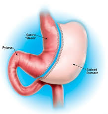 Constatin din brașov a împlinit 5 ani de la înființare, perioadă în care au fost internați peste 30.000 de pacienți. Unde Se Poate Face Gastric Sleeve In Romania Tratamentul Obezitatii