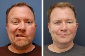Bell's palsy usually begins with a sudden feeling of weakness or paralysis on 1 side of the face. Improving Quality Of Life For Facial Paralysis Patients