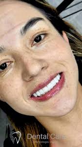 Que esperas para mejorar tu sonrisa?💎 #sonrisanatural Dr. HAROLD SOLANO  🇨🇴🇧🇷 📲 317 3821091