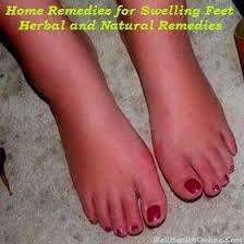 Home Remedies For Swelling Feet Herbal And Natural Remedies Foot Remedies Remedies Home Remedies