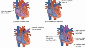 Difference Between Cyanotic And Acyanotic Congenital Heart Defects Youtube