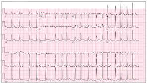 Image result for Synchronized Cardioversion