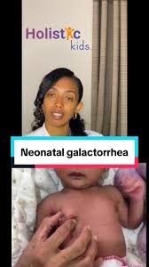 Image result for Galactorrhea