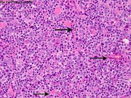 Its characteristic feature is the formation in the lymph nodes of seals with an infiltrate in the form of immunoblasts and plasma cells. Histopathology Images Of Angioimmunoblastic T Cell Lymphoma Aitl By Pathpedia Com Pathology E Atlas