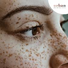 Image result for Freckled skin
