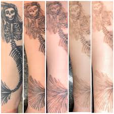 Laser tattoo removal session may take one or two weeks to heal completely. Tattoo Removal Process Pictures 4 Sessions Into The Process Tattooremoval
