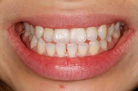 Check spelling or type a new query. Underbite Adjusted With Adult Braces Beyond Infinity Dental