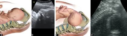 Image result for Manual Rotation in Occipitoposterior Presentation