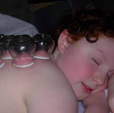 Cupping Therapy in Beaverton, OR