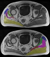 Tailored Atlas Of The Residual Limb Above And Sound Limb Below At Download Scientific Diagram