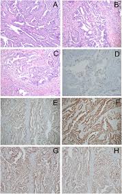 Endometrial cancer (more common) and uterine sarcoma. Diagnosis And Management Of A Recurrent Polymerase Epsilon Pole Mutated Endometrial Cancer Gynecologic Oncology