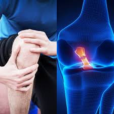 Acl Tear Symptoms Causes 7 Ways To Recover Dr Axe Acl Tear Acl Tear Symptoms Acl Tear Recovery