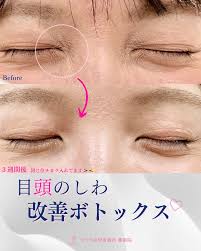 目頭 シワ 改善