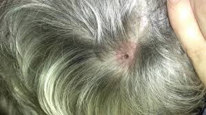 Check spelling or type a new query. Hello Found A Rather Concerning Tick Bite On My Dog This Afternoon Above Right Shoulder Centered Towards Her Neck I Removed The Petcoach