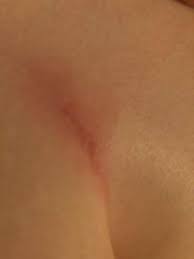 Kratzer Unter Der Brust