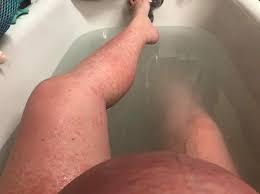 Usually after you give birth, the puppp rash will go away within one to two weeks. Puppp Rash And How To Treat It Quickly Twiniversity 1 Twin Pregnancy Site