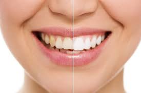 Zoom is a bleaching process widely used throughout the country and around the world to lighten discoloration of enamel and dentin. How To Prepare For Your In Office Tooth Whitening Treatment
